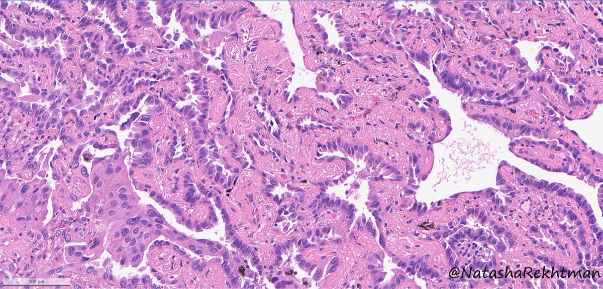 Hi friends!
Anyone up for a long overdue #NatPathPuzzler 🔬🧩?
Well… ready or not, here it comes.
Lung nodule in a patient with history for breast carcinoma.
Are you team H&amp;E or team IHC - is IHC needed here?
#PulmPath <a href="/PulmPathSoc/">PPS</a> <a href="/MSKPathology/">MSK Department of Pathology & Laboratory Medicine</a>