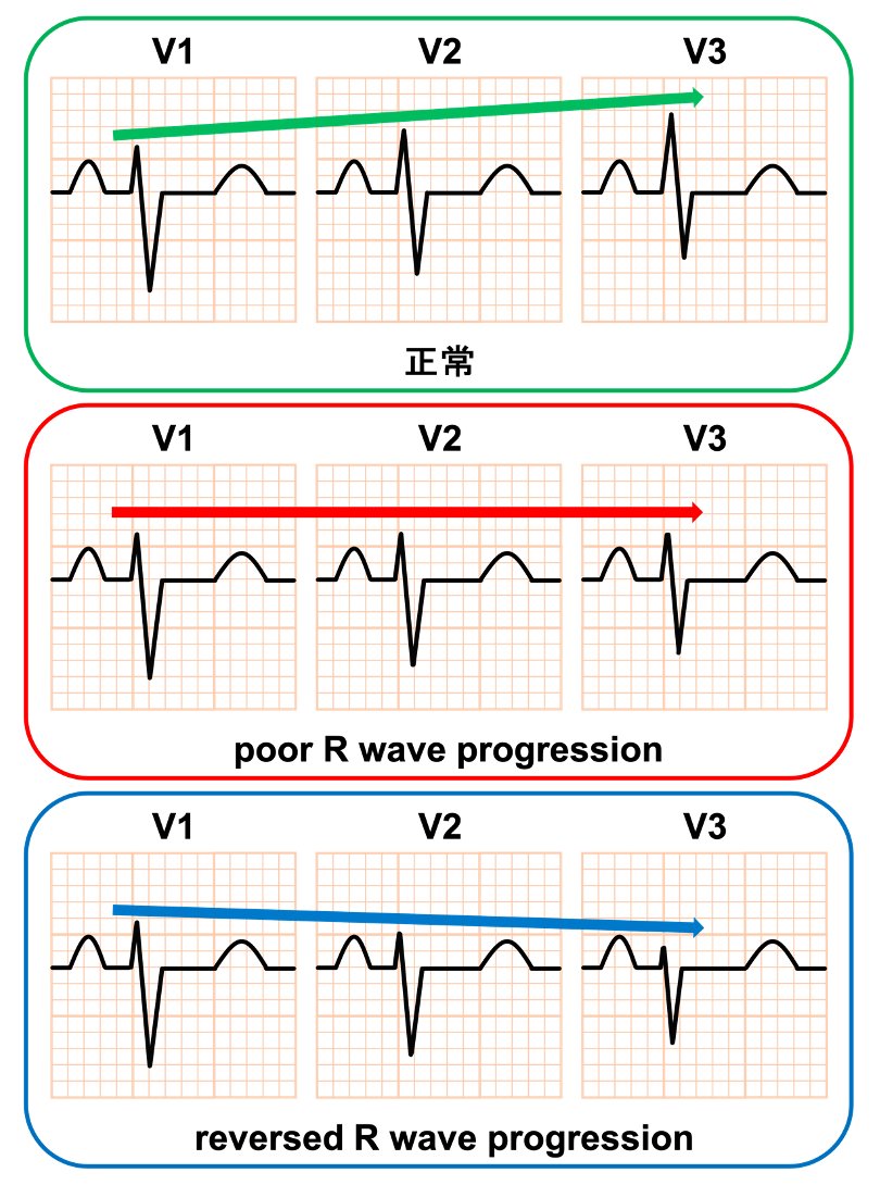 Poor R Wav Progression 通常、R波はV1からV3にかけて高くなっていきますが、Poor R wave ProgressionではR波の増高が乏しく、reversed ...