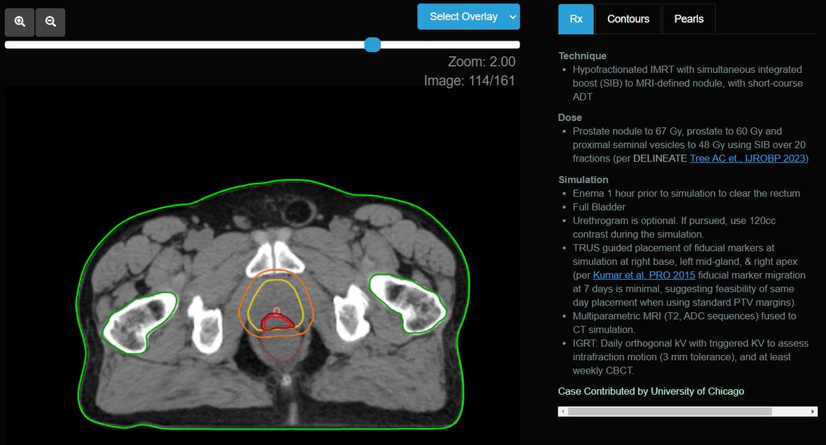 eContour (@econtourradonc) on Twitter photo 🚨NEW CASE ALERT!🚨
<a href="/Aranee1330/">Aranee Sivananthan</a> from <a href="/UChicagoRadonc/">University of Chicago Radiation Oncology</a> submitted a 🌟prostate case with an MRI-delineated DIL boost!
econtour.org/cases/163
Just look at that nodule and that urethra!
PS: brush up on your MRI knowledge as we discuss tumor signal intensity on T2 & ADC series! 🚨NEW CASE ALERT!🚨
<a href="/Aranee1330/">Aranee Sivananthan</a> from <a href="/UChicagoRadonc/">University of Chicago Radiation Oncology</a> submitted a 🌟prostate case with an MRI-delineated DIL boost!
econtour.org/cases/163
Just look at that nodule and that urethra!
PS: brush up on your MRI knowledge as we discuss tumor signal intensity on T2 & ADC series!