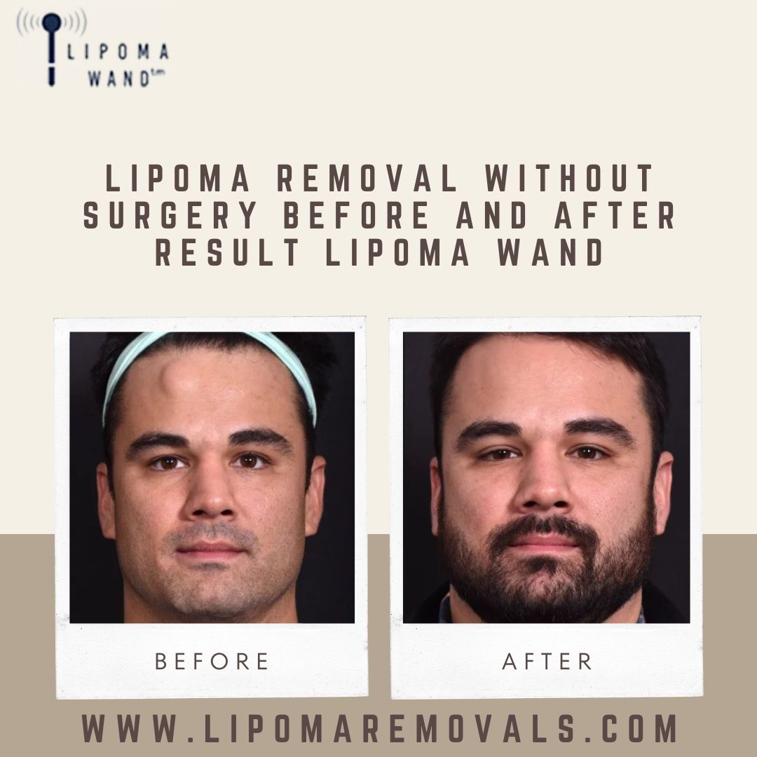 Check out these incredible before and after results that showcase the power of non-invasive lipoma removal. 

Visit the website: lipomaremovals.com

Call us: +805 277 9092

#LipomaTreatment #LipomaWand #LipolysisJelly #LipomaRemoval #NaturalTreatment #Lipomawand
