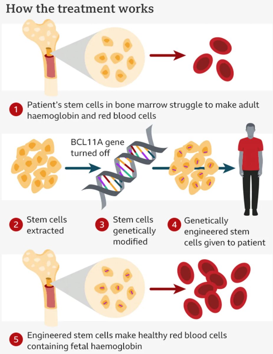 The UK authorities have agreed to provide ex-vivo gene editing therapy as part of the National Health Service for Beta Thalassaemia. This is important because it demonstrates that good value innovative therapies will be funded, despite the cost. tinyurl.com/5cxydk7v #NHS