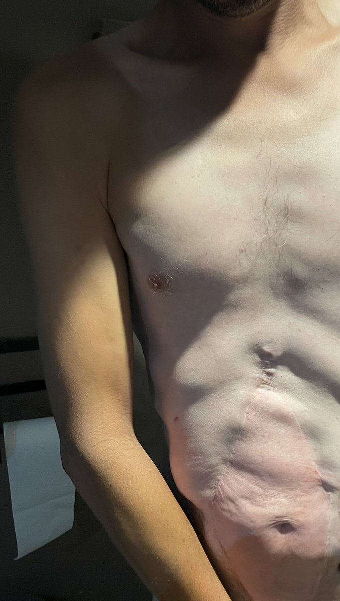 Adam Alderson (@adamalderson3) on Twitter photo It’s subtle but it’s there ! After a rough night I’ve noticed a rash on my donor abdominal wall which could be a sign of early solid organ rejection. Now I wait to see if I need biopsies or intervention to stop it. <a href="/ttsorg/">TTS</a> <a href="/BasingstokePmi/">PMI Basingstoke</a> <a href="/henkpgiele/">Henk Giele</a> #lifeonextratime #PMP #cancer It’s subtle but it’s there ! After a rough night I’ve noticed a rash on my donor abdominal wall which could be a sign of early solid organ rejection. Now I wait to see if I need biopsies or intervention to stop it. <a href="/ttsorg/">TTS</a> <a href="/BasingstokePmi/">PMI Basingstoke</a> <a href="/henkpgiele/">Henk Giele</a> #lifeonextratime #PMP #cancer