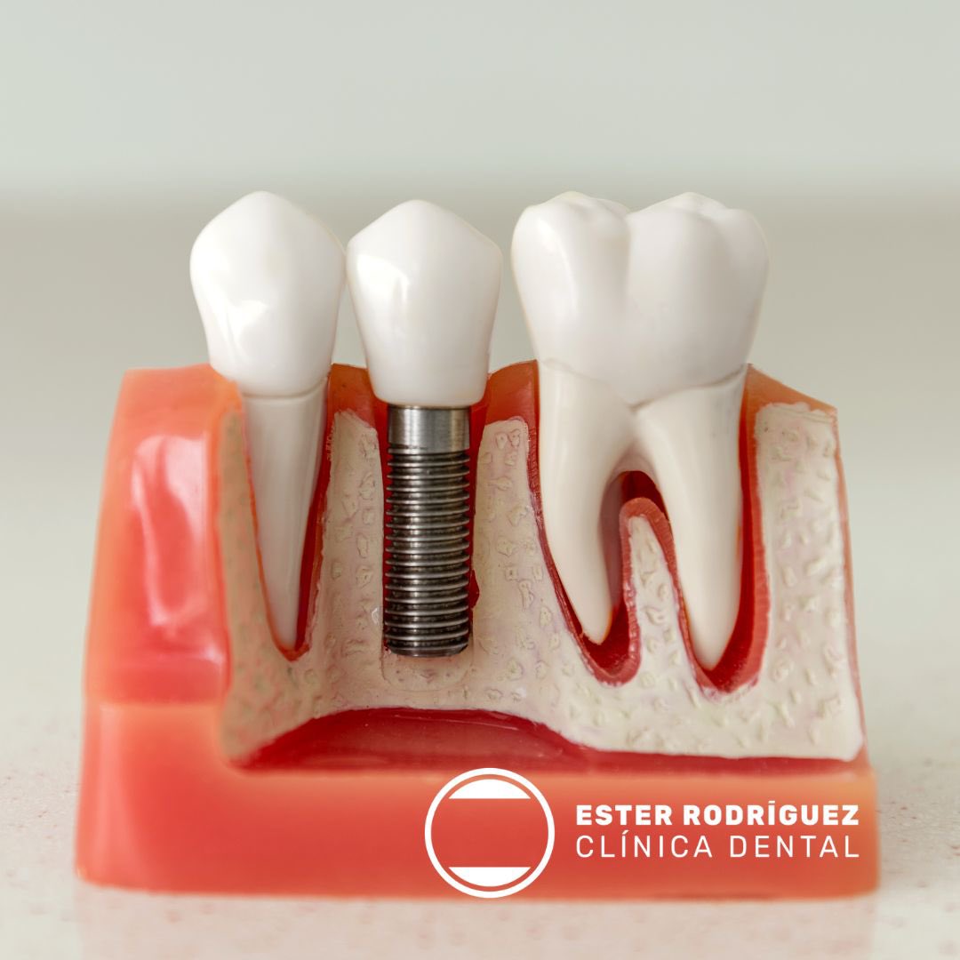 ester_dental's tweet photo. ¿Cuáles son los pasos a seguir en la colocación de un implante dental?

✅Consulta inicial para realizar un buen plan de tratamiento.

✅ Estudio previo con la realización de un TAC maxilar y un escaneado de la boca.

✅ Confección y prueba de la férula quirúrgica. https://t.co/2yUaDU4f0B