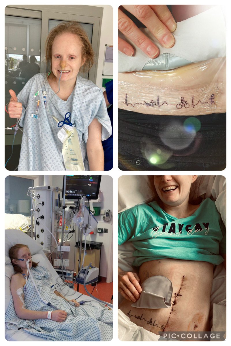 Resus2Runner's tweet photo. I canโt tell you how much this means to mean! ๐ฅน
My 10th #triathlon since my #CancerDiagnosis & #ICU stay in 2017.
I know from the outside I look well, but with a metre of scar, a stoma, rib, sternum & vertebrae fractures from #CPR, every triathlon means so much ๐ซถ๐ป
#TRItanium https://t.co/o9BMOohWtT