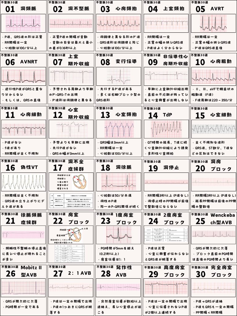 ecgkuma's tweet photo. 心電図の学習をはじめたあなたへ。
基本的な不整脈を30個図解にしました。 https://t.co/xfpcXOmB9i