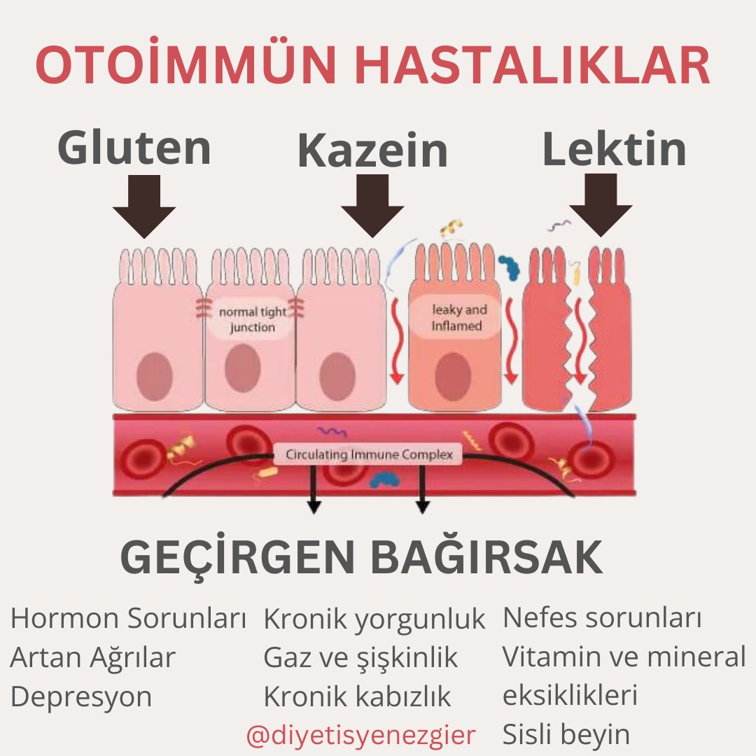 diyetisyenezgi's tweet photo. 1) GEÇİRGEN BAĞIRSAK OLDUĞUMU NASIL ANLARIM ? 

Öncelikle otoimmün bir hastalığınız var ise ve yaşam kalitenizin düştüğünü hissediyorsanız 👉 geçirgen bağırsak ile karşı karşıya olduğunuza emin olabilirsiniz‼️ https://t.co/AfCpfviHji