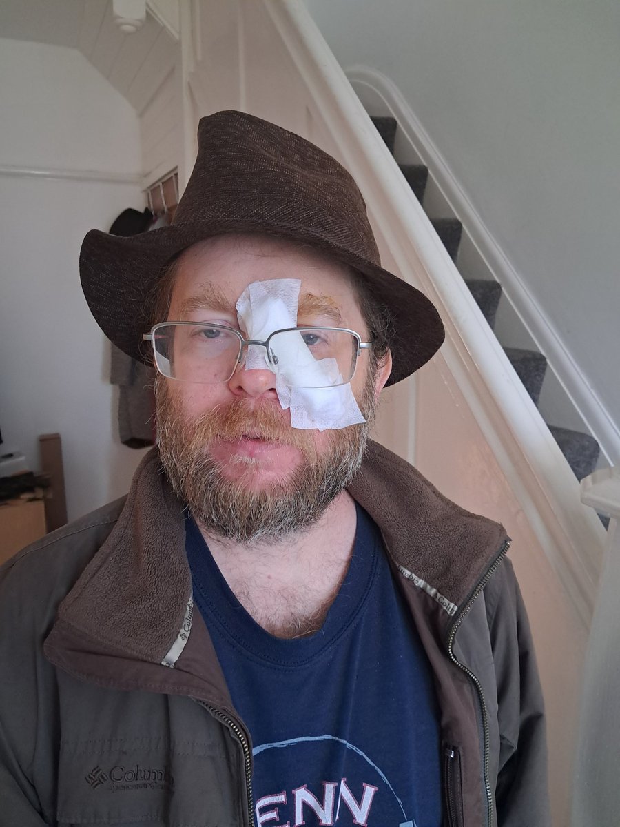 FlintDibble's tweet photo. An immigrant attacked me today with a knife. Slicing my face right near my eye. He removed a carcinoma and made a wide excision. Expertly stitching me up to ensure the wound wouldn't impact my eye and minimize the scar. Big props to the NHS and to immigrants! https://t.co/PeCNuoeP37