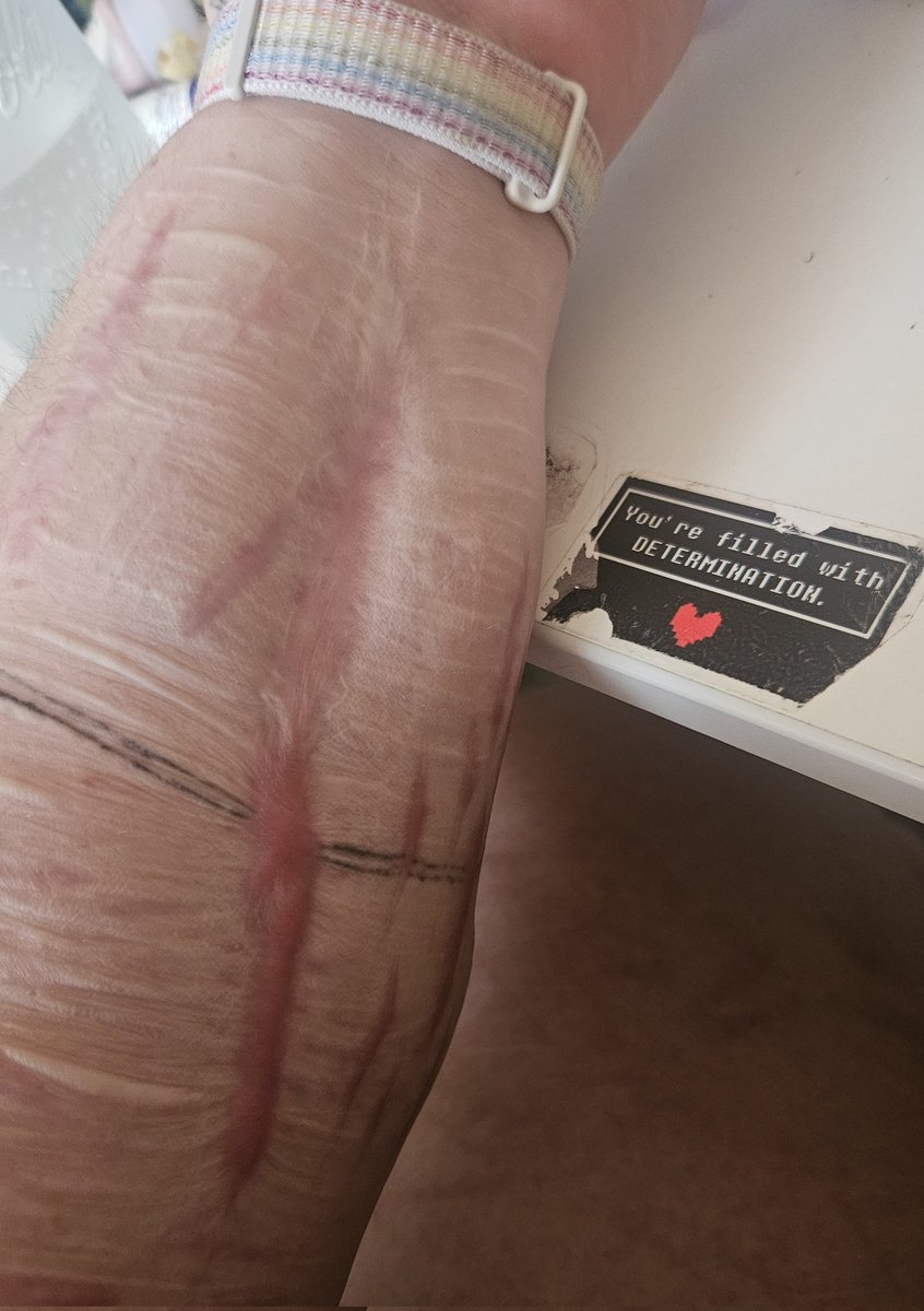 candysblood's tweet photo. look at my sick scar https://t.co/v4LyPnmHAt