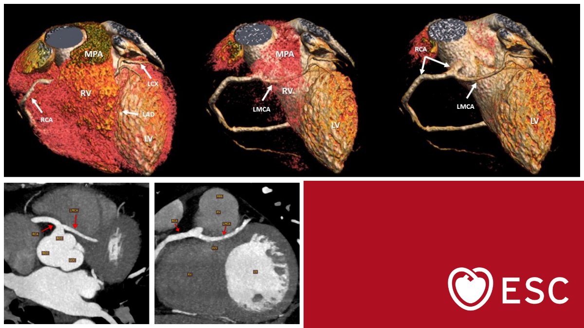 #ImageOfTheWeek by Mahmoud Naseem Shaaban from the Aswan Heart Centre (Magdi Yacoub Foundation), Aswan, Egypt.

What is the course of this anomalous left main coronary artery (LMCA) originating from the right coronary artery (RCA)? bit.ly/4dbzm0C

#cardioed #ESCYoung
