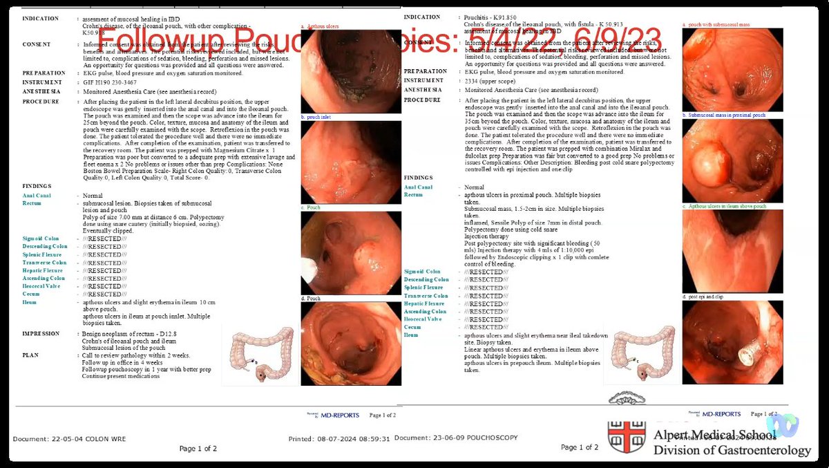 drRobinDud's tweet photo. Despite 🏝️🌞🌊holidays , another valuable meeting with @MRegueiroMD & #IBDologists from 🇺🇸
2⃣ instructive cases of pts with severe, complicated #IBD 💗a lot of knowledge🦉by @DrSamirAShah1 who took care⚕️ of them with improvement 👏🫶💪
Great talk by @BinionMd & @SWexner ✍️
@ibdlive #IBDlive @CleClinicMD
