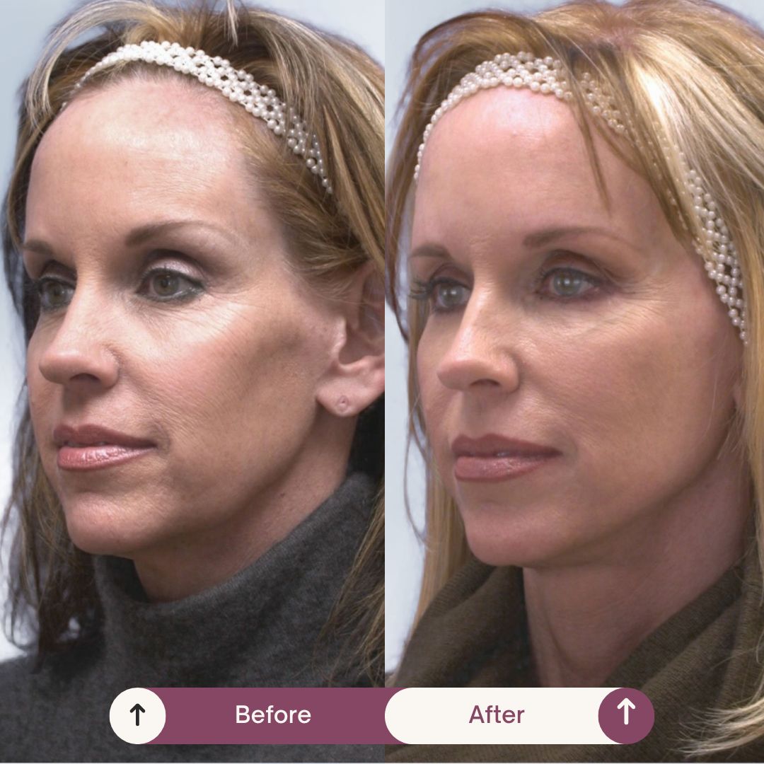 EvolvMD's tweet photo. PSA: Gravity does not have to win. Aging skin can mean sagging skin, but it is not set in stone. Restore volume, smooth wrinkles, &amp; improve skin texture with Sculptra. 

This month, save $780 on our Skin Rejuvenation package. Learn more: https://t.co/83NVrz7pwP

#sculptra#skin https://t.co/VxD3sxRQuB
