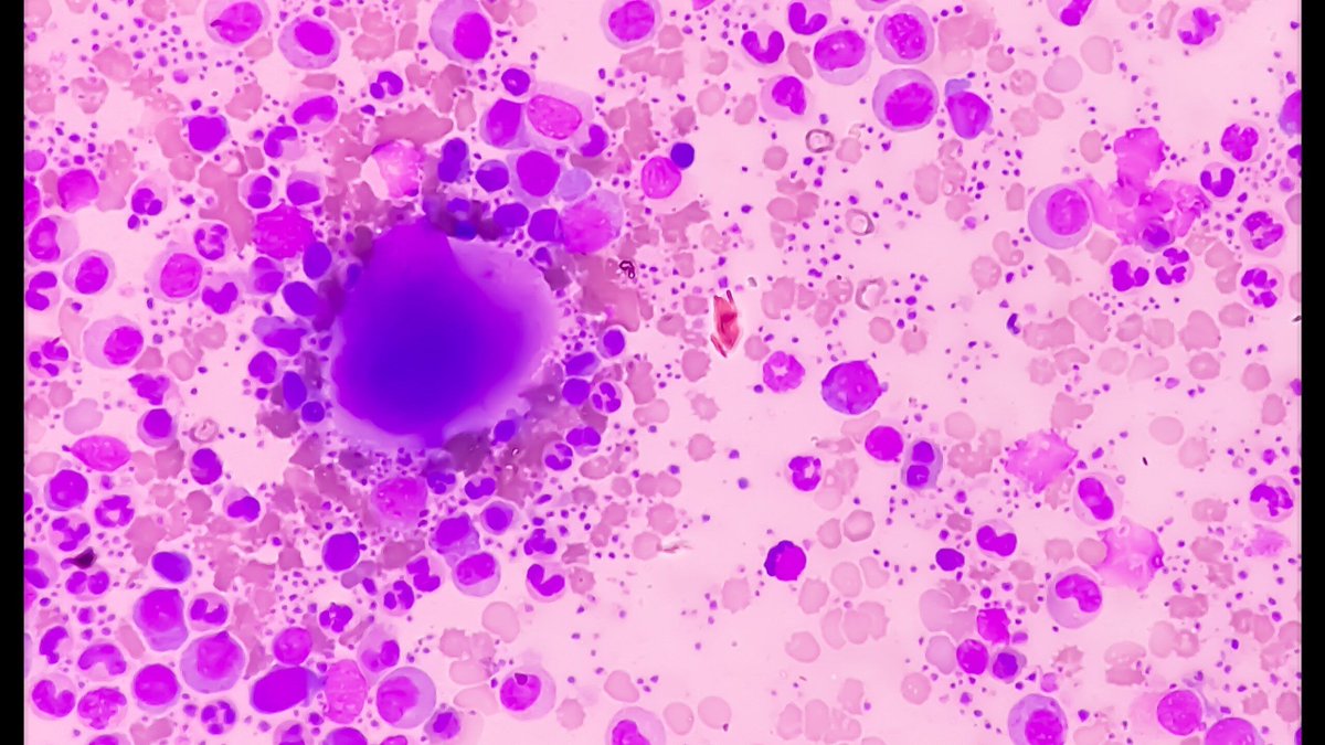 Blood_Cancers's tweet image. Blockage of CTLA-4, an immune checkpoint receptor on T cells, appeared to boost the cytotoxic T-cell–mediated immune response against #myelofibrosis cells in human xenografts.

📰 Read more: buff.ly/46CCQ9V

@LaraTavernari @RuggieroNorfo @RM_Lab_ @AjHematology