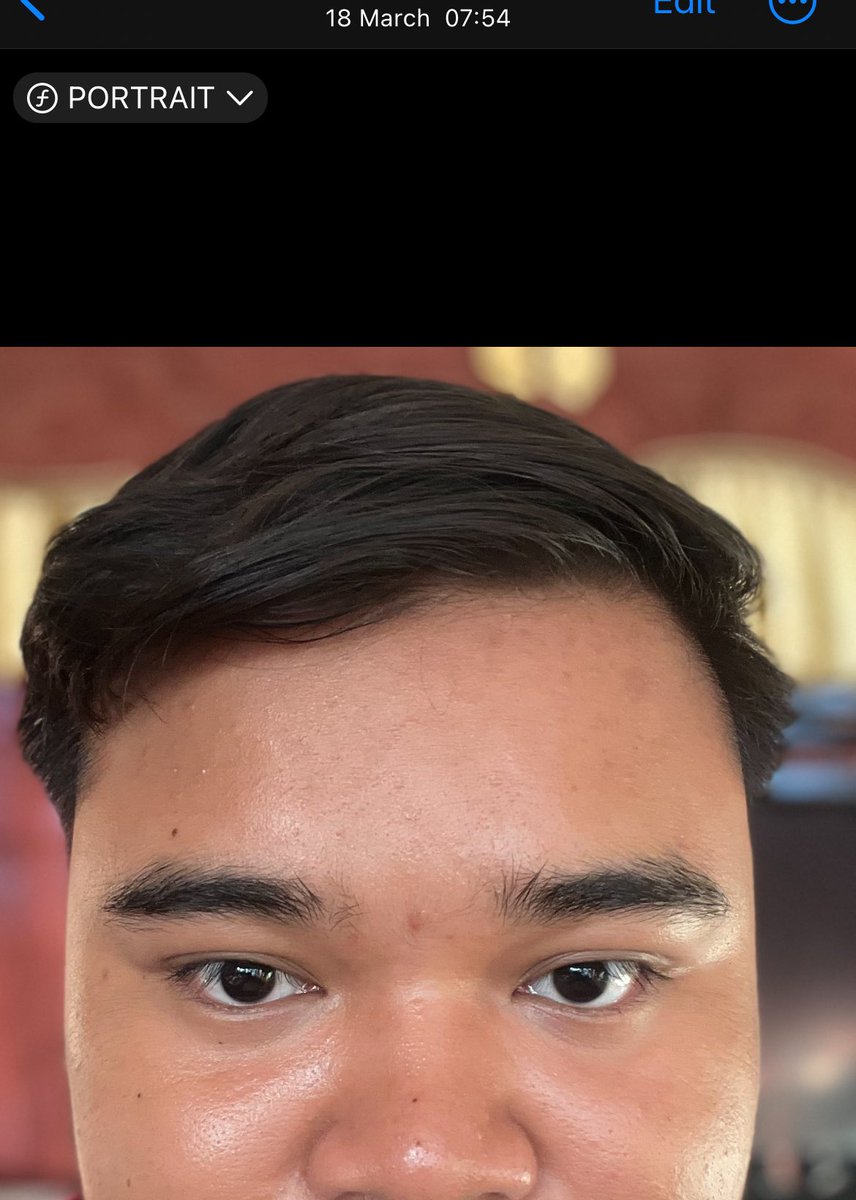 Dahi boleh licin kalau rajin pakai toner pads. I’m not kidding ☝🏻

Toner pads yang I guna sekarang, buat kulit I makin smooth &amp; glowing + parut pun cepat pudar.

(Ini gambar before > after bulan March haritu)