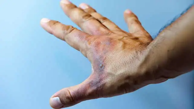 Ug_RedCrossCFA's tweet photo. 🩹 First Aid Tip: Treating Minor Burns 🔥

Accidentally touched something hot? Here’s what to do:

Cool the burn: Immediately run cool (not cold) water over the burn for at least 10-15 minutes to reduce pain and swelling.

#firstaidtip https://t.co/SESOidsQyD