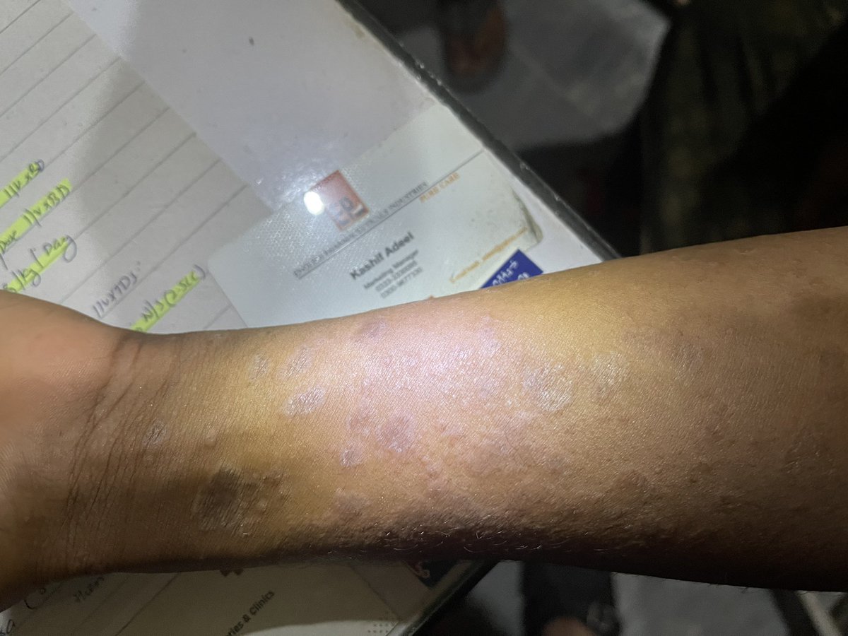 DrMedica_13's tweet image. #Clinical_Case✨

An 18 year old girl presented with this complain for 1 month. It is associated with mild to moderate #itching. 

No hx of joint pain, hair fall and oral ulcers. 

What is the #Diagnosis? 

@Drkhenaizan @Dr_Derma_ @dermatology @SFT_DermaClub