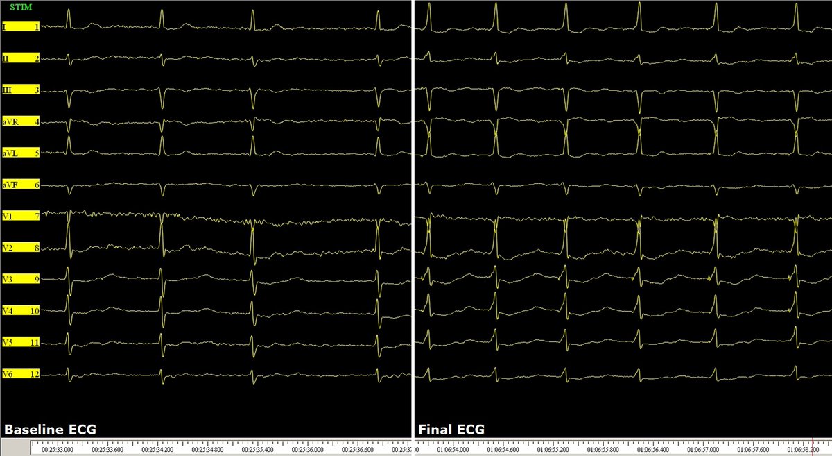 Giovanni Coluccia (@messapus) on Twitter photo 85M w/brady persAF and presyncope. #DontDisTheHis HBP is not dead! #Epeeps, some interesting, sweet findings (HB COI, transient traumatic RBBB and consequently different capture morphologies), good parameters (HB capt threshold 0.8 V @ 0.5 ms; 7 mV) and nice result! <a href="/GDandamudiMD/">Gopi Dandamudi</a> 85M w/brady persAF and presyncope. #DontDisTheHis HBP is not dead! #Epeeps, some interesting, sweet findings (HB COI, transient traumatic RBBB and consequently different capture morphologies), good parameters (HB capt threshold 0.8 V @ 0.5 ms; 7 mV) and nice result! <a href="/GDandamudiMD/">Gopi Dandamudi</a>