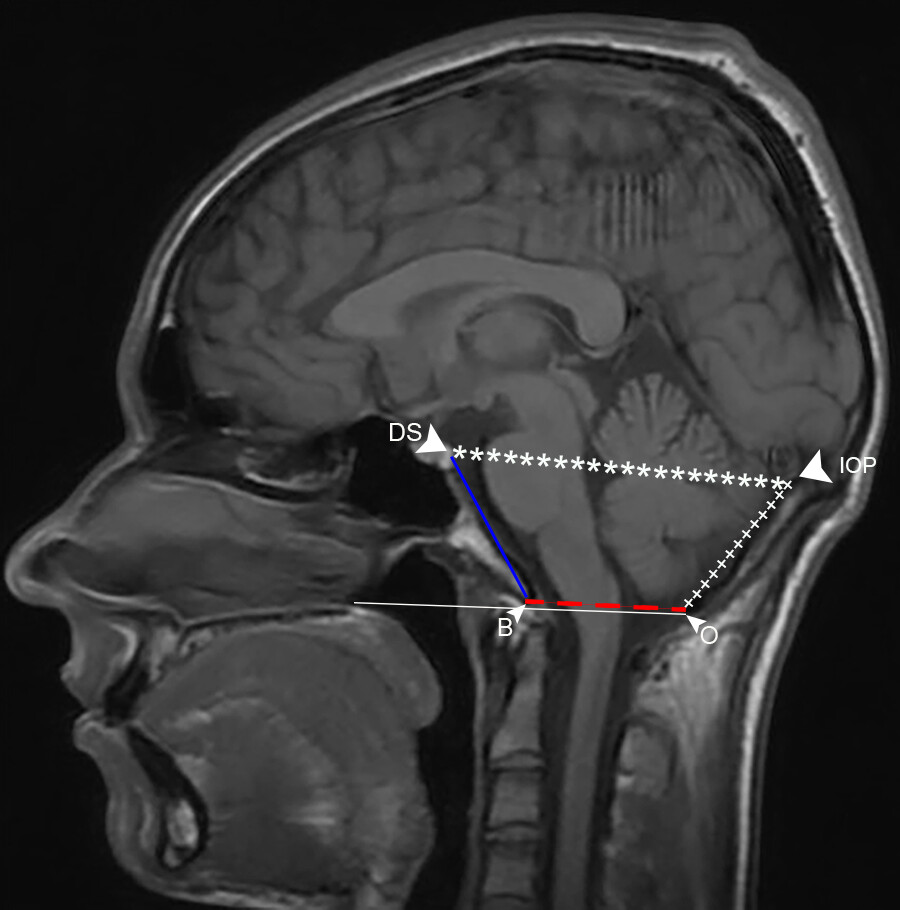 draash's tweet photo. Chiari I Deformity: Beyond 5 mm below the Foramen Magnum | RadioGraphics https://t.co/uzxmExoVox https://t.co/0ulcFZwhVR