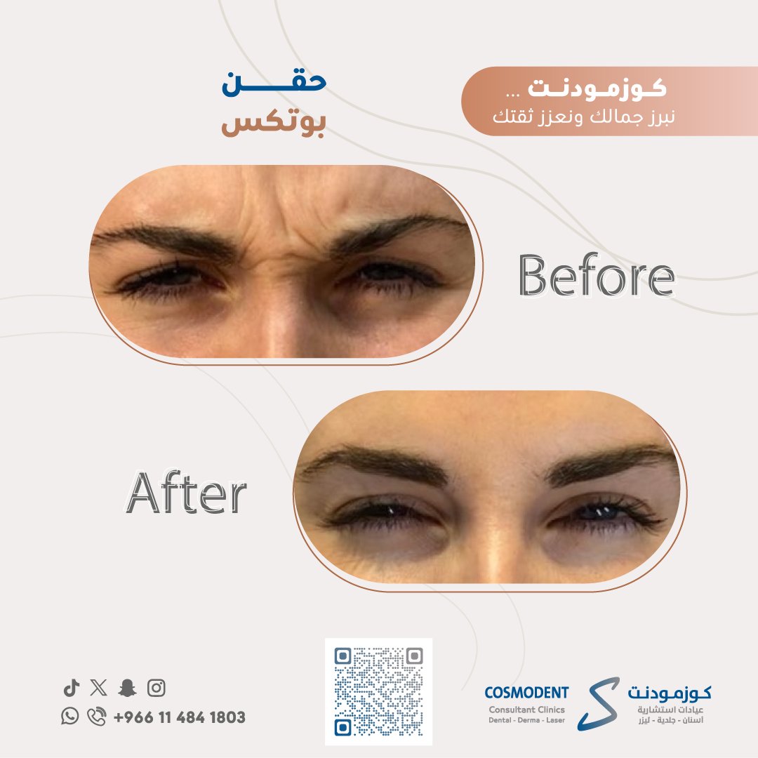 cosmodent_ksa's tweet photo. حقن البوتكس | BOTOX Injections

(قبل وبعد)

كوزمودنت عيادات استشارية
"نبرز جمالك و نعزز ثقتك"

#كوزمودنت
#اسنان - #جلدية - #ليزر
#cosmodent
#جلديةوتجميل

_______
#جلسة #botox #injections #بوتكس #حقن_بوتكس #عيادات #عيادات_الرياض #عروض #النرجس #جمالك #عيادة_تجميل #الرياض_الآن #عرض https://t.co/XLDIqVzKyc