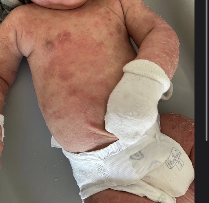 BioavailableNd's tweet image. I will never let another baby go through what my son went through. 

I woke with the best clients! Focusing on nutrient density like gelatine and meat stocks can do wonders, my clients baby before and after 1 consultation with me ! #eczema #clientwins