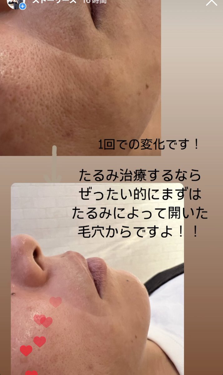 RYOSUKEHAYASHI4's tweet photo. 引き締まったハリのある肌に変えていきますよ😊 https://t.co/jLWdwJYrmF