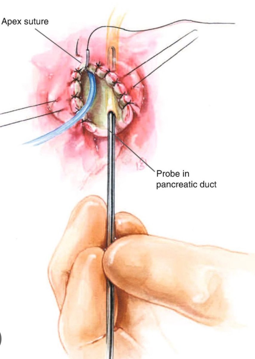 Syed A. Ahmad (@syedaahmad5) on Twitter photo Sphincteroplasty. White catheter in bike duct. Red catheter in pancreas duct. <a href="/SAGES_Updates/">SAGES is in Tampa in 2026!</a> <a href="/juliomayol/">Julio Mayol</a> <a href="/TomVargheseJr/">Tom Varghese Jr. MD, MS, MBA, FACS, MAMSE 🇺🇸</a> Sphincteroplasty. White catheter in bike duct. Red catheter in pancreas duct. <a href="/SAGES_Updates/">SAGES is in Tampa in 2026!</a> <a href="/juliomayol/">Julio Mayol</a> <a href="/TomVargheseJr/">Tom Varghese Jr. MD, MS, MBA, FACS, MAMSE 🇺🇸</a>