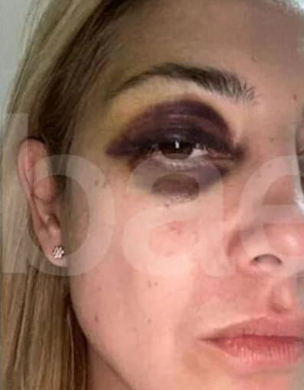 A riesgo de que me puteen pero no me importa porque es cosa de todos los días, un oftalmólogo que me conteste: 
¿Se puede tener el ojo tan bien con supuesto semejante piñón?