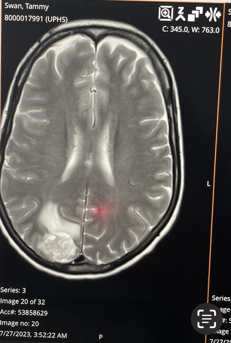 Dear Oncologists: please perform brain MRIs annually even for early stage. Found one year ago today when I permanently lost peripheral vision.  This is what standard of care monitoring gets you.  
#NSCLC #EGFR #stage4 #oligoprogression #METamp