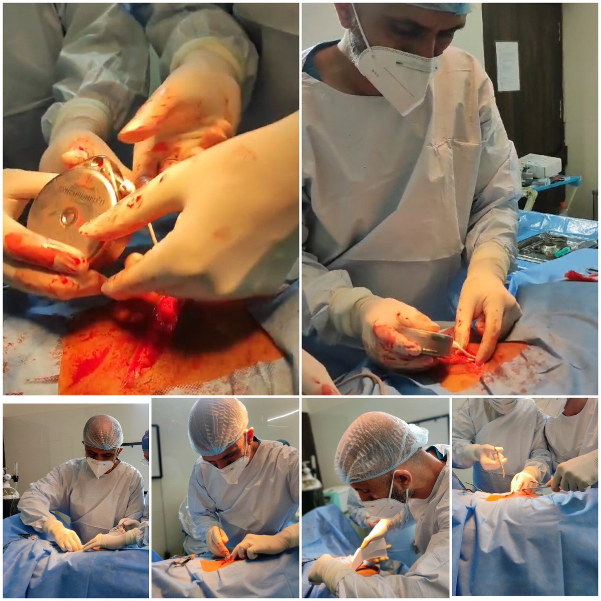 dbibra's tweet photo. We implanted Intrathecal Drug Delivery System (IDDS) in a patient of Spasticity. It will help inrehab and improved quality of life
@IntlNeuromod #paindoctor #spasticity #baclofenpump https://t.co/CRKsHSDX2W