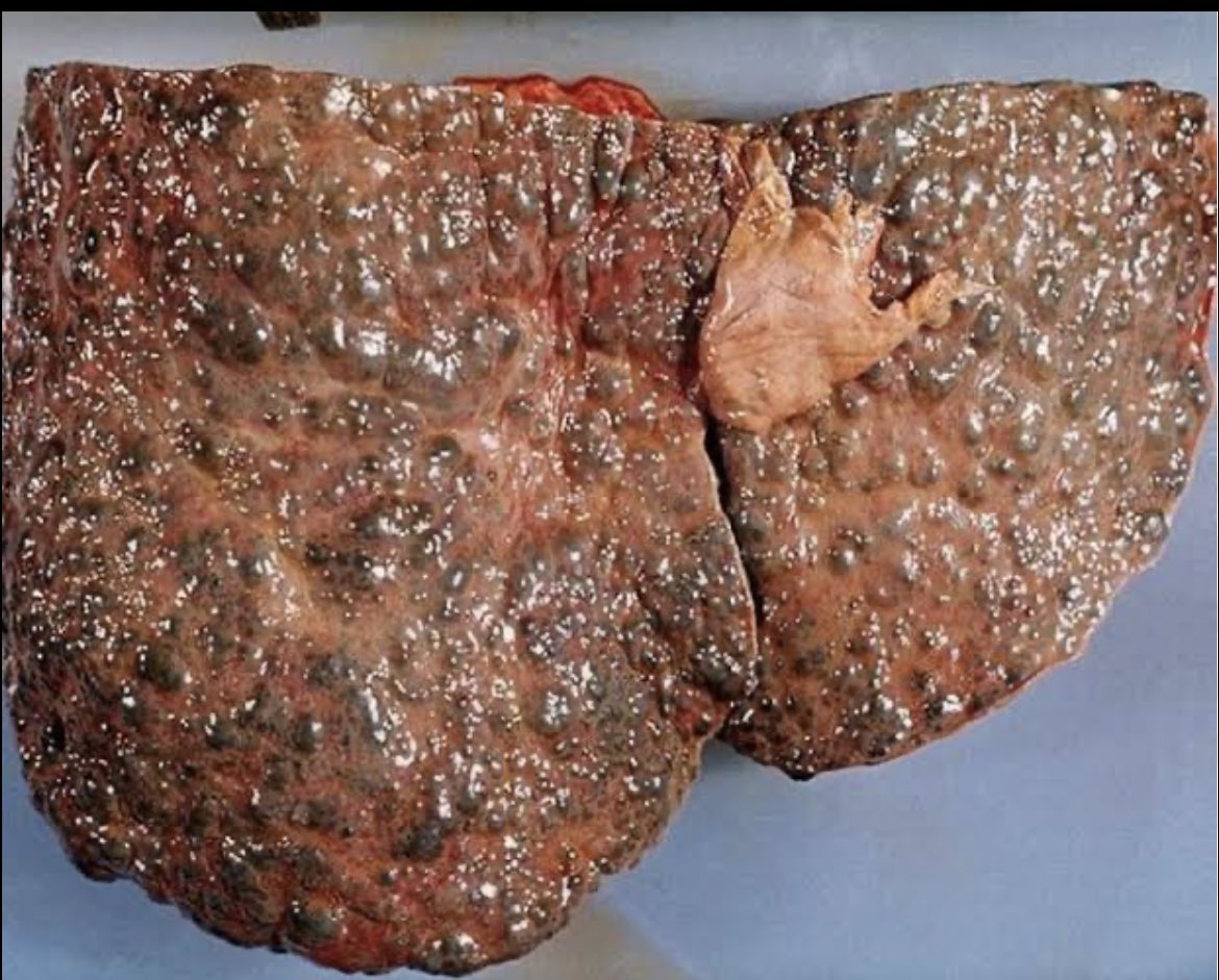 zizelle_'s tweet image. LIVER CIRRHOSIS 

This is what your liver would look like if you keep binging on alcohol every weekend.

Liver cirrhosis is the final stage of chronic liver disease.

All you need to know is contained in the thread👇🏼