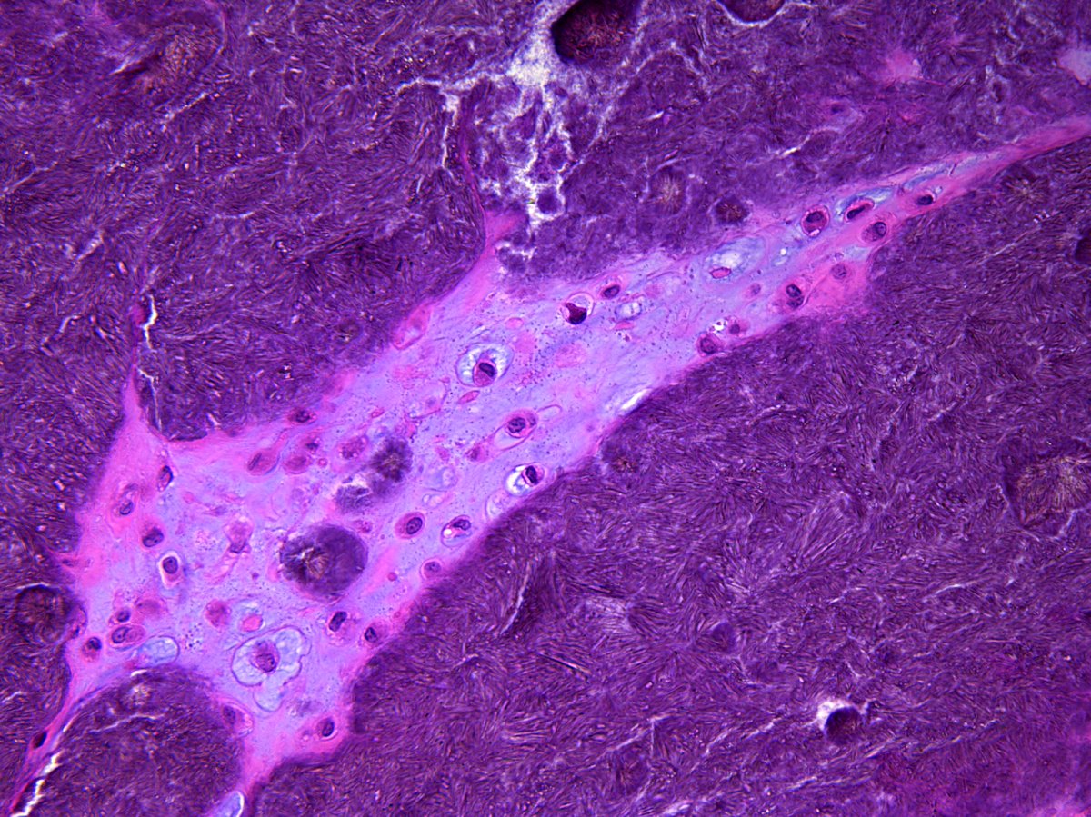 Pathology Walker@Auto Tweet Bot tweet media