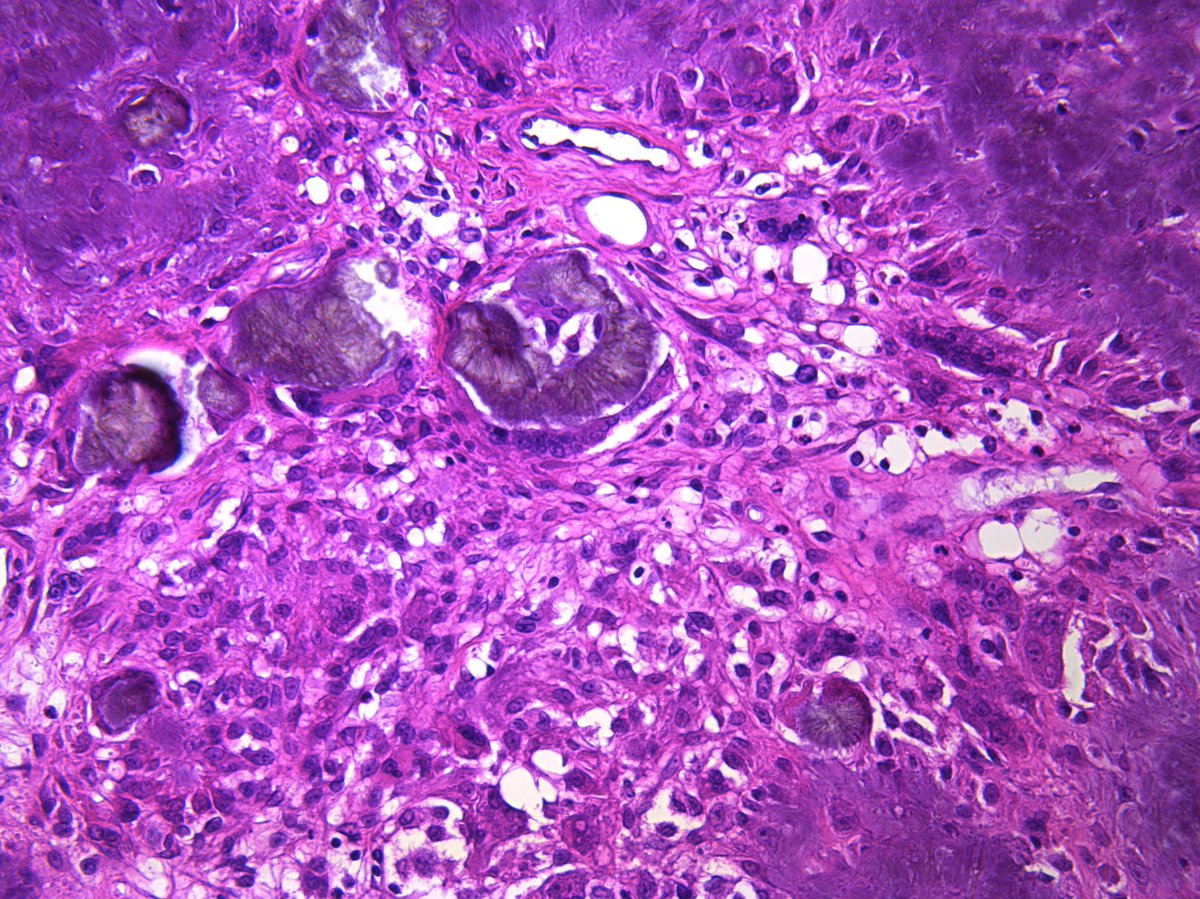 Pathology Walker@Auto Tweet Bot tweet media