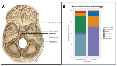 GJBrainResearch (@gjbrainresearch) on Twitter photo 📢Our latest clinical study in <a href="/BMJOncology/">BMJ Oncology</a> sheds new light on the neurosurgical management of rare skull base cancers in the UK, crucial for advancing treatment strategies including advanced surgery and proton beam therapy #Chordoma #Chondrosarcoma
bmjoncology.bmj.com/content/3/1/e0… 📢Our latest clinical study in <a href="/BMJOncology/">BMJ Oncology</a> sheds new light on the neurosurgical management of rare skull base cancers in the UK, crucial for advancing treatment strategies including advanced surgery and proton beam therapy #Chordoma #Chondrosarcoma
bmjoncology.bmj.com/content/3/1/e0…