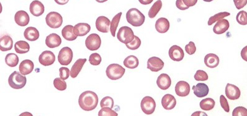 Cincinnati Childrenās Research (@cincyresearch) on Twitter photo #SickleCell therapy developed <a href="/CincyChildrens/">Cincinnati Children's</a> <a href="/ChildrensCBDI/">CincyChildren's CBDI</a> shows long-term safety in mice. Data supported launch of phase 1/2 first-in-human clinical trial in the U.S. Congrats to Dr. Malik and colleagues! #stemcell #genetherapy Findings <a href="/PLOSONE/">PLOS One</a> ncbi.nlm.nih.gov/pmc/articles/P⦠#SickleCell therapy developed <a href="/CincyChildrens/">Cincinnati Children's</a> <a href="/ChildrensCBDI/">CincyChildren's CBDI</a> shows long-term safety in mice. Data supported launch of phase 1/2 first-in-human clinical trial in the U.S. Congrats to Dr. Malik and colleagues! #stemcell #genetherapy Findings <a href="/PLOSONE/">PLOS One</a> ncbi.nlm.nih.gov/pmc/articles/Pā¦