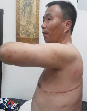 yabaleftonline's tweet photo. Chinese organ harvesting victim wakes up chained to the bed with parts of the liver and lung missing. https://t.co/5y52Xh6dUC