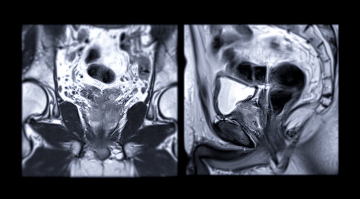 Should #MRI be Mandatory Prior to Active Surveillance for Patients with Intermediate Risk #ProstateCancer?
diagnosticimaging.com/view/mri-activ…
<a href="/ACRRFS/">ACR RFS</a> <a href="/ACRYPS/">ACR YPS</a> <a href="/RadiologyACR/">American College of Radiology</a> <a href="/ARRS_Radiology/">ARRS</a> <a href="/RSNA/">RSNA</a> <a href="/SocietyAbdRad/">Society of Abdominal Radiology | SAR</a> <a href="/DukeRadiology/">Duke Radiology</a> <a href="/PennRadiology/">Penn Radiology</a> <a href="/MontefioreRAD/">Montefiore Radiology</a> <a href="/UABRadiology/">UAB Radiology</a> 
#radiology #RadRes