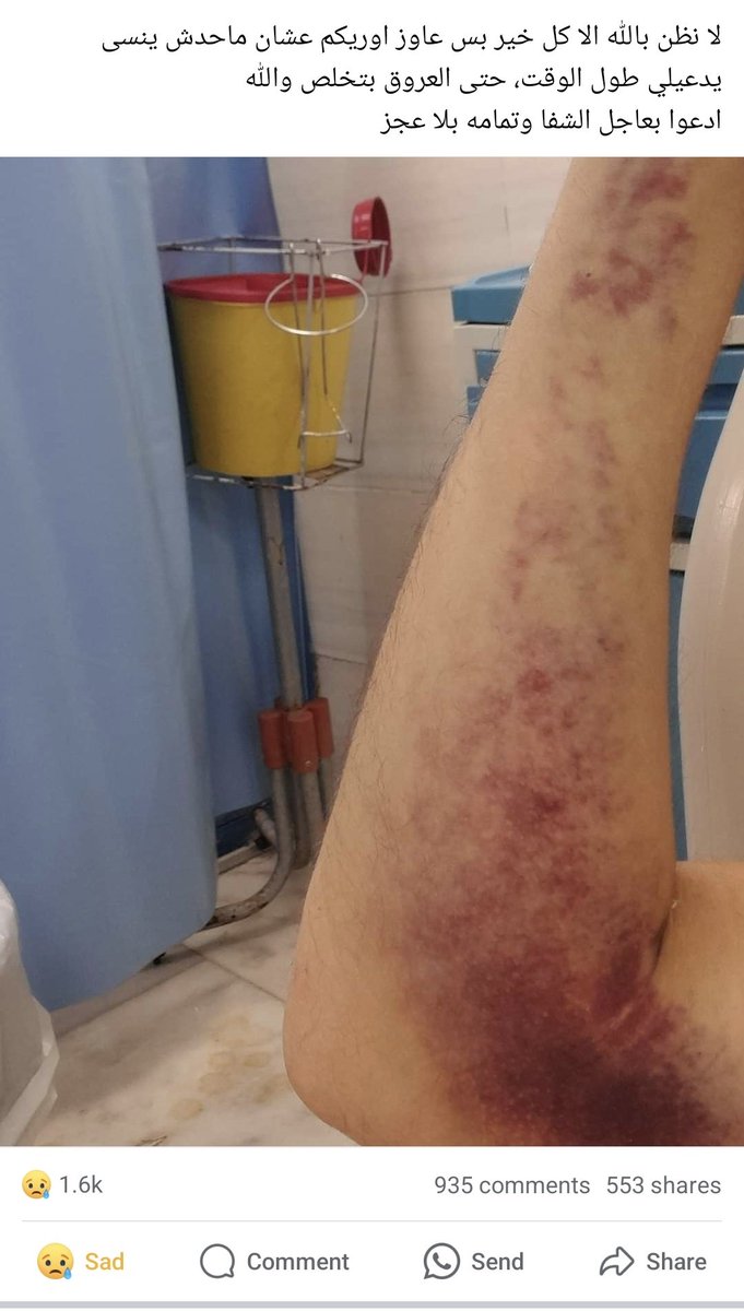 AliGom3aaa's tweet photo. ضروري محتاجين مساعدتكم لعلاج صديقي و أخي الدكتور احمد فوزي مريض بسرطان الدم الفلوس اللي جمعناها بتخلص و دلوقتي كل يوم بنحتاج ١٥ ألف جنية ادوية و صفائح دموية فيا ريت اللي يقدر يساعد ميتأخرش 
ريتويت ضروري هيفرق كتير
الرقم ده عليه instapay
01288534980
و ده محفظة 
01147277479 https://t.co/vHkeE2XrD4
