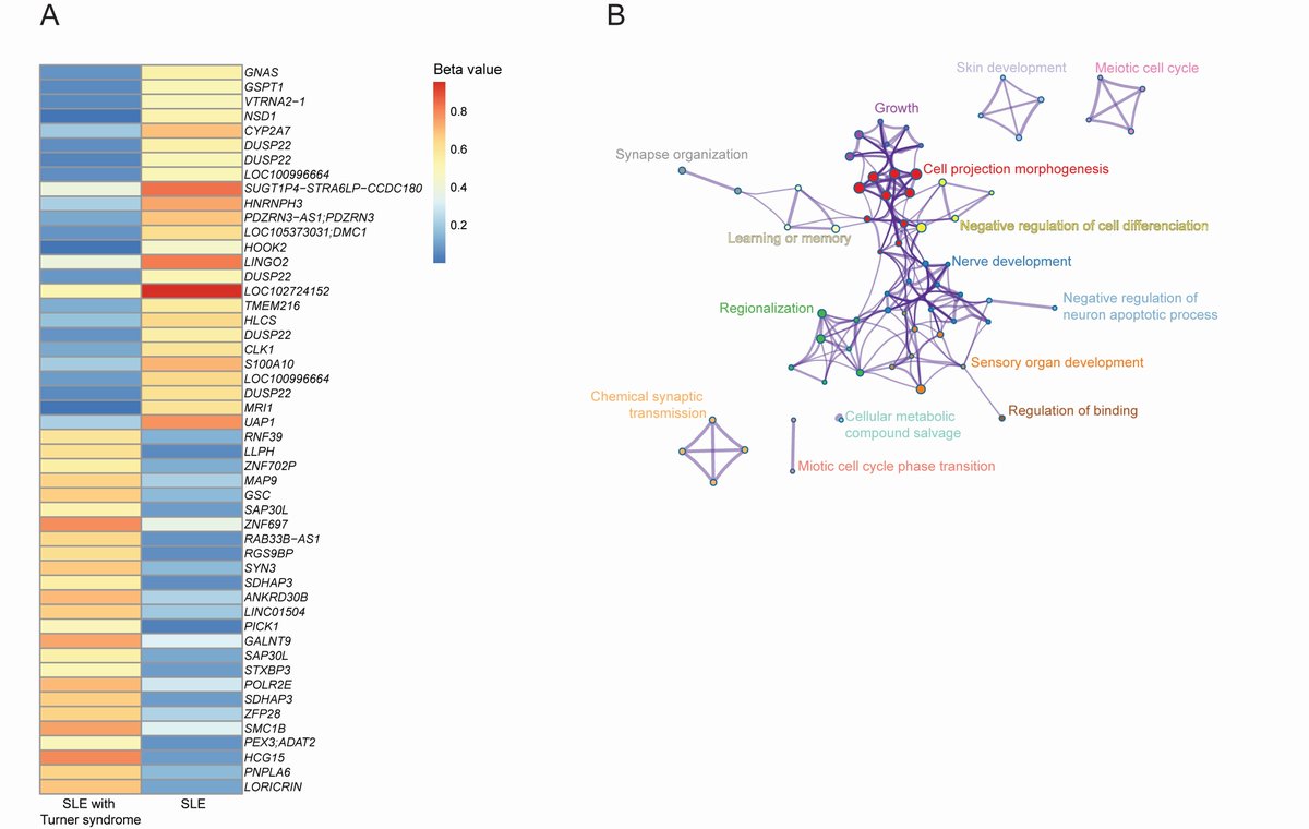 Amr Sawalha, MD (@asawalha) on Twitter photo 🔬🧬 New study of a rare #lupus case in Turner syndrome suggests a link between X-chromosome dosage and lupus #epigenetics. Could this explain sex-bias in lupus and the low lupus incidence in Turner syndrome?🤔<a href="/UPMCPhysicianEd/">UPMC Physician Resources</a> <a href="/PittRheum/">PittRheum</a> <a href="/PittPediatrics/">Pitt Department of Pediatrics</a> sciencedirect.com/science/articl… 🔬🧬 New study of a rare #lupus case in Turner syndrome suggests a link between X-chromosome dosage and lupus #epigenetics. Could this explain sex-bias in lupus and the low lupus incidence in Turner syndrome?🤔<a href="/UPMCPhysicianEd/">UPMC Physician Resources</a> <a href="/PittRheum/">PittRheum</a> <a href="/PittPediatrics/">Pitt Department of Pediatrics</a> sciencedirect.com/science/articl…