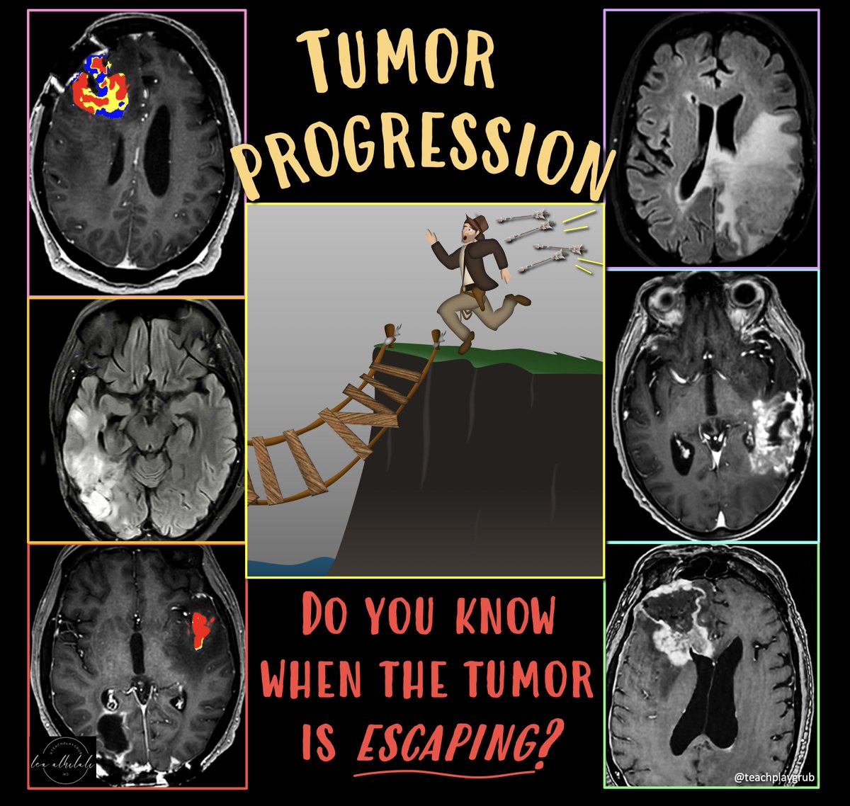 1/Tired of stressing if a brain tumor is progressing?

Wish you had some insurance about calling tumor recurrence?

Here’s the cheat sheet you NEED for the best signs of tumor progression!