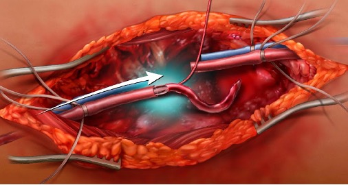 ManualofSurgery's tweet photo. Do you know how to place a temporary vascular shunt? What if you had to place one tonight? Mark Bowyer and @gross_cl  show us how!
@KijabeHospital
@VUMCGlobalSurg
@cosecsa
@rcsi_cosecsa
#trauma #some4surgery #GlobalSurgery
https://t.co/t8nPdcHC7J https://t.co/l3SpbQrxQx