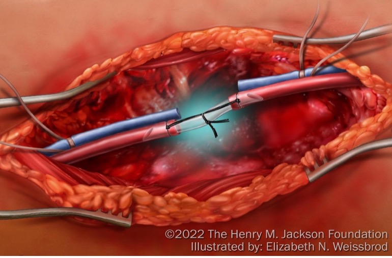 ManualofSurgery's tweet photo. Do you know how to place a temporary vascular shunt? What if you had to place one tonight? Mark Bowyer and @gross_cl  show us how!
@KijabeHospital
@VUMCGlobalSurg
@cosecsa
@rcsi_cosecsa
#trauma #some4surgery #GlobalSurgery
https://t.co/t8nPdcHC7J https://t.co/l3SpbQrxQx