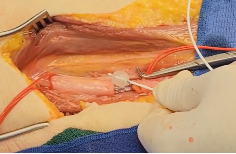 ManualofSurgery's tweet photo. Do you know how to place a temporary vascular shunt? What if you had to place one tonight? Mark Bowyer and @gross_cl  show us how!
@KijabeHospital
@VUMCGlobalSurg
@cosecsa
@rcsi_cosecsa
#trauma #some4surgery #GlobalSurgery
https://t.co/t8nPdcHC7J https://t.co/l3SpbQrxQx