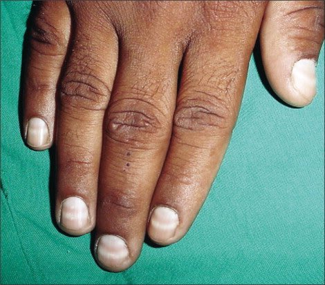 hemo_shk's tweet image. A 19-year-old man presented with pedal oedema and facial puffiness of 3 months&apos; duration.
#General physical examination showed periorbital swelling, pallor, nail changes, and pedal oedema.
#Systemic examination was unremarkable.
•What is this nail sign called,and what could be…