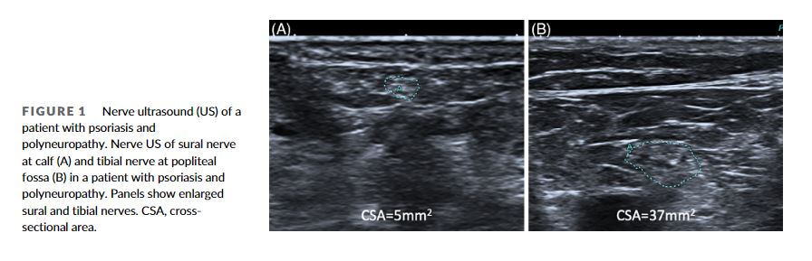 Psoriasis and psoriatic arthritis appear to be associated with an increased risk of PN which is linked to higher prevalence of contributing factors. onlinelibrary.wiley.com/doi/10.1002/mu…