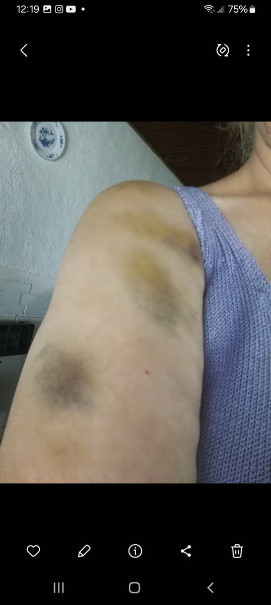 ritabea21's tweet photo. @VivianaaFerrari Estos son golpes evolucionando en días y son reales xq los sufrí yo x parte de un familiar https://t.co/9EcbCmulbf