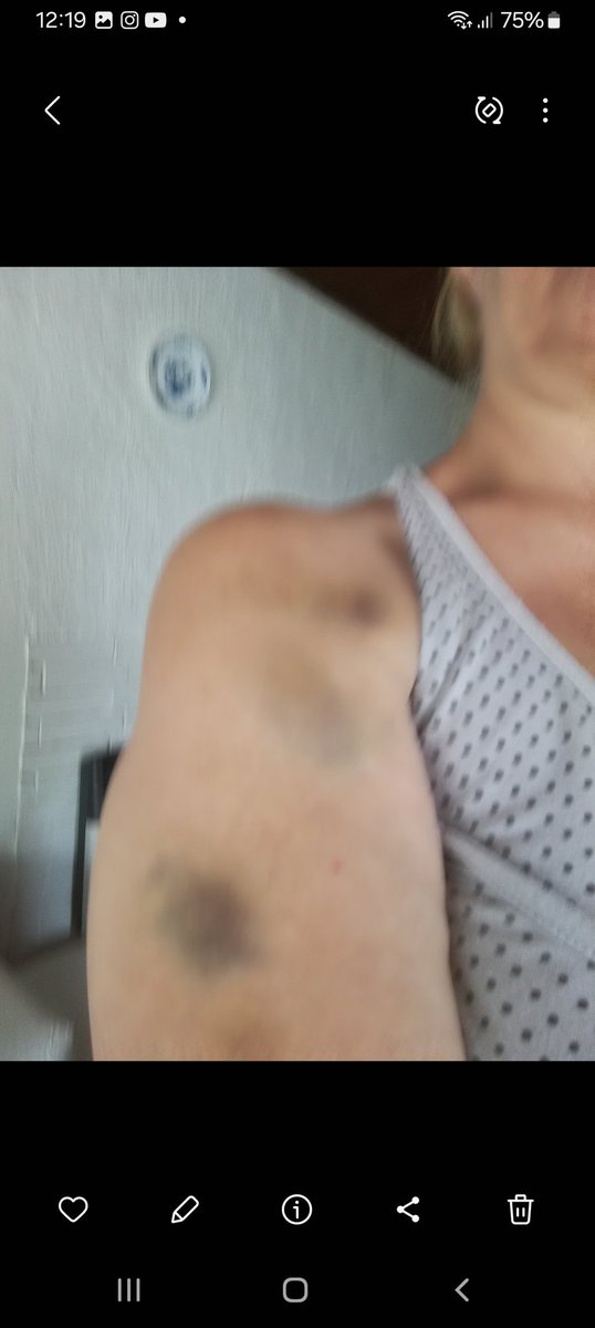 ritabea21's tweet photo. @VivianaaFerrari Estos son golpes evolucionando en días y son reales xq los sufrí yo x parte de un familiar https://t.co/9EcbCmulbf
