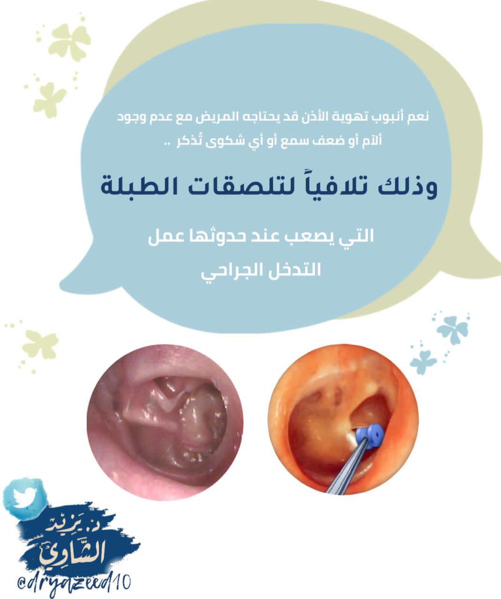 👂انابيب تهوية الأذن ..