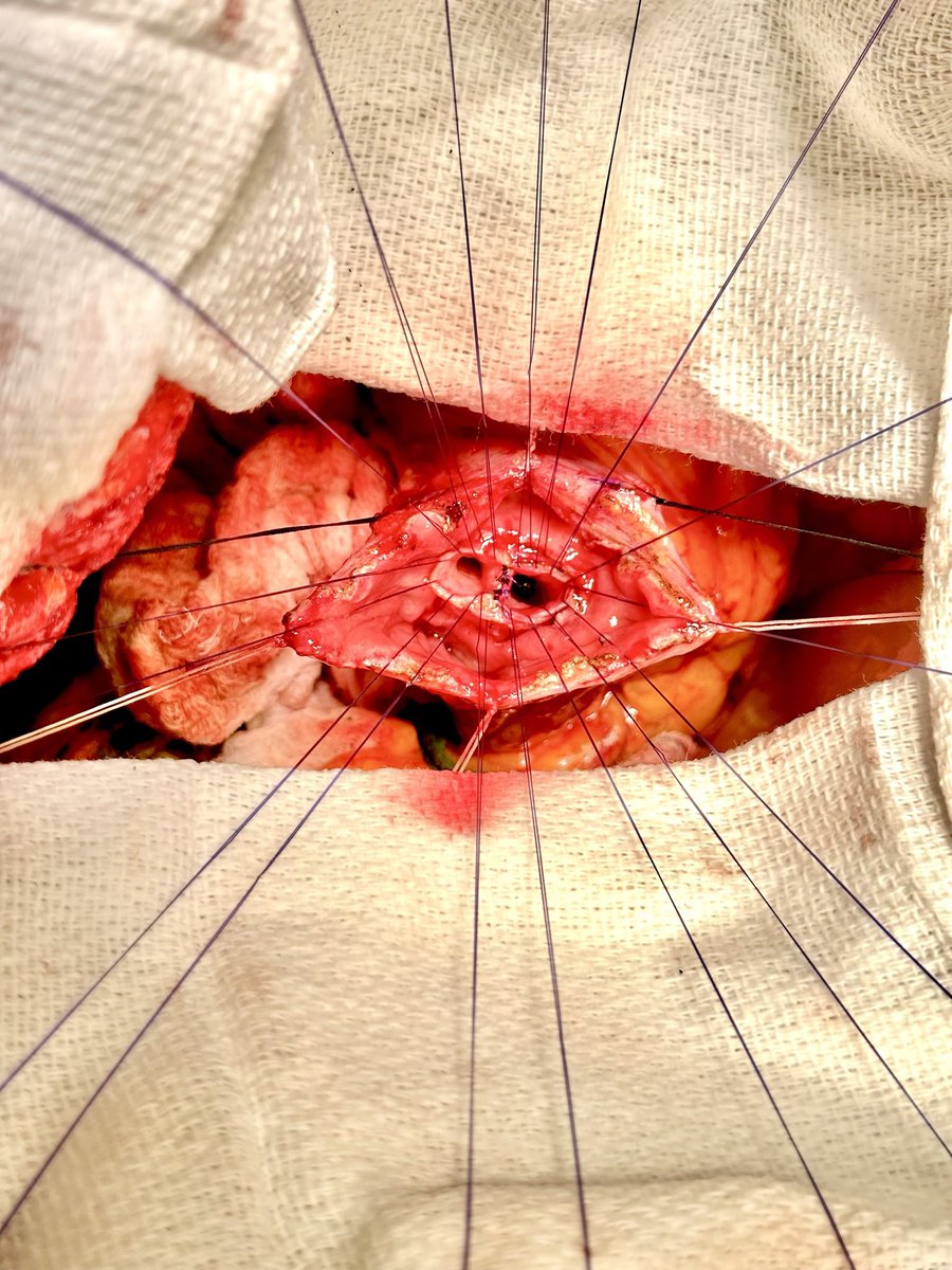 AsadAzim's tweet photo. @SyedAAhmad5 @pplo59 @SAGES_Updates @juliomayol @TomVargheseJr Same scenario - did ampullectomy https://t.co/82uVIHck5a
