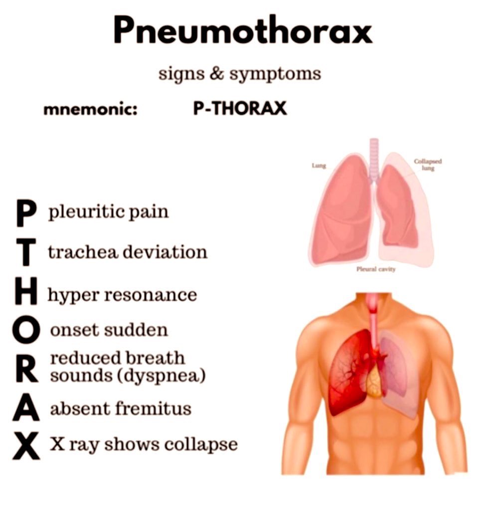 Doctors__squad's tweet photo. Pneumothorax 📌 https://t.co/OPb3qmuzTq