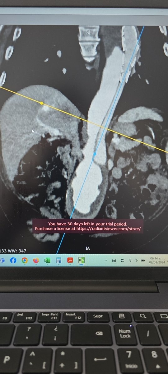 filiummd's tweet photo. 48Y male, chonic TBAD with large AAA. TEVAR 6 months ago to seal proximal tear. Now enlarging aneurism. WWYD? @farkomd @XavierBerardMD @radcliffeVASCU @ReneLizola @CarlosAHinojosa @VascularEscotto https://t.co/VlA27NgM3t