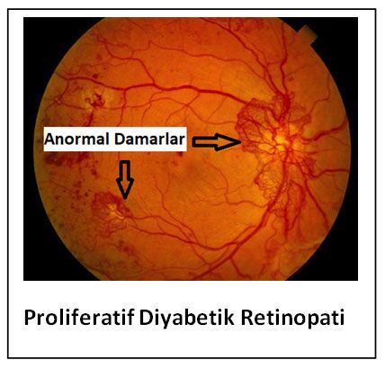 🔴KANDA YÜKSEK GLİKOZ = GÖRME KAYBI (retinopati)

🔶️YÜKSEK HbA1c=GÖRME KAYBI (retinopati)

🔶️BENFOTİAMİN'in diyabete bağlı 
Böbrek, Sinir, Göz,Beyin hasarını önleme fonksiyonu

🔊Çok basit şekilde; eğer HbA1c 6 ve üzeri ise biliniz ki diğer organlarda hasar görmekle birlikte